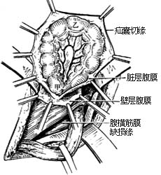 復發性腹股溝疝