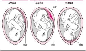 胎盤早剝