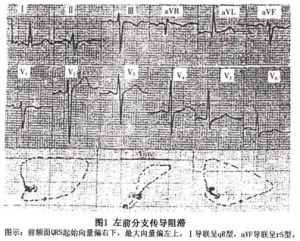 左前分支傳導阻滯