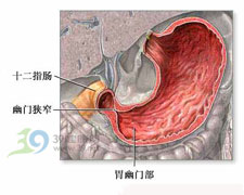 小兒消化性潰瘍