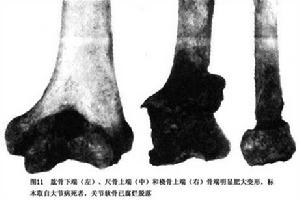 瀰漫性特發性骨肥厚