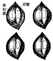 鼻淚管堵塞