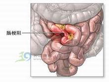 小兒動力性腸梗阻