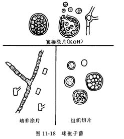 （圖）類球孢子菌病