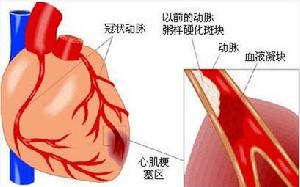 心肌梗死后綜合征