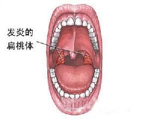 舌根部淋巴濾泡增生