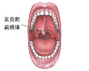 淋巴濾泡增生