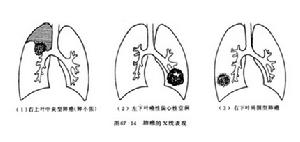 支氣管肺癌