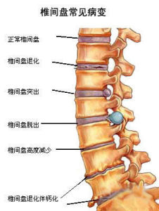 椎管狹窄