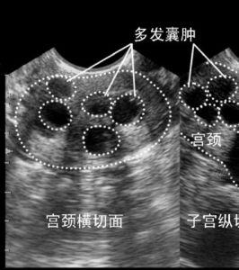 宮頸腺囊腫