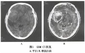 膠質母細胞瘤