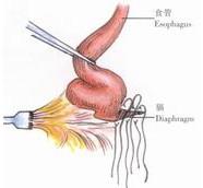 示意圖8:在食管後方間斷縫合食管裂孔