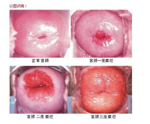 正常、輕度、中度、重度宮頸