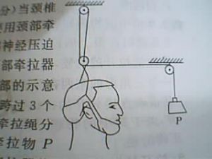 頸椎牽拉