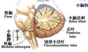 小腦中下腳綜合徵