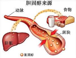 膽固醇高