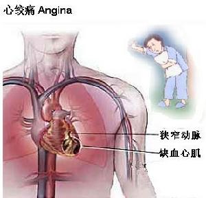 變異型心絞痛