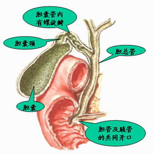 先天性膽管擴張症