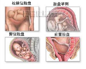 胎盤的過早分離