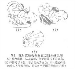 持續性枕後位難產