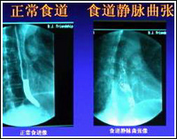 門靜脈高壓性胃病