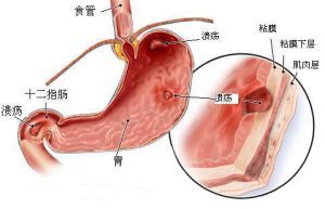 胃十二指腸潰瘍