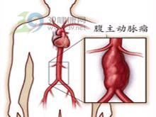 腹主動脈瘤