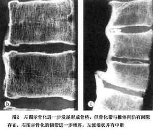 瀰漫性特發性骨肥厚