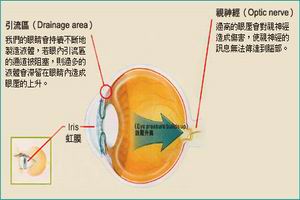 原發性青光眼