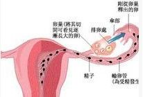 輸卵管復通