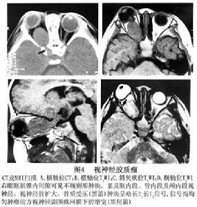 視神經膠質瘤