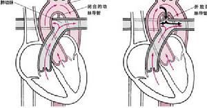 胸降主動脈動脈瘤