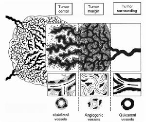 （圖）腫瘤血管