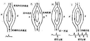 陣發性心動過速