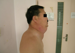 良性對稱性脂肪瘤病(Benign Symmetric Lipo-matosis，BSL)