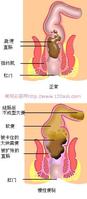 器質性便秘