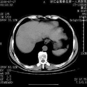 計算機體層攝影