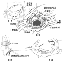 心房間隔缺損