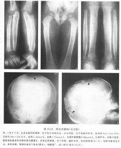 軟骨發育不全