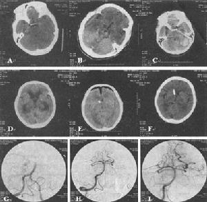（圖）腦內動脈瘤