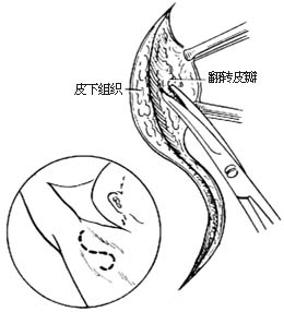 臭汗症