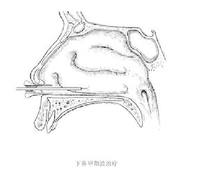 《鼻部常用操作技術》