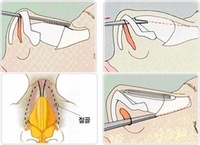 鷹勾鼻矯正術