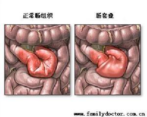 急性腸梗阻