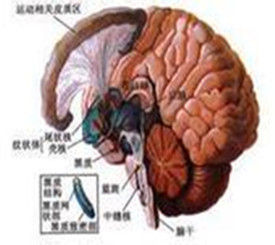 進行性核上麻痹