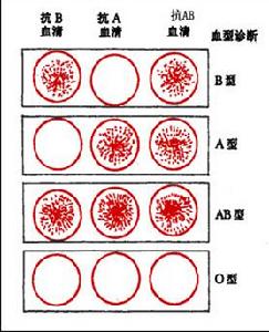 RH血型不合溶血病