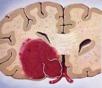 腦動脈血管瘤