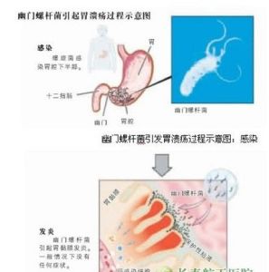 幽門螺桿菌感染