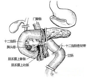 壺腹癌