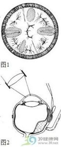 視網膜下液引流術